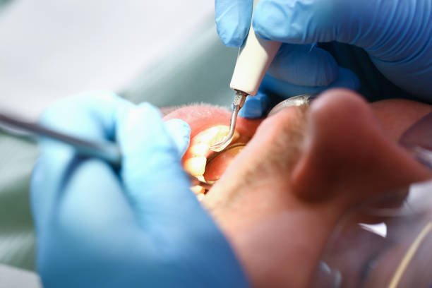 Best Emergency Dentist for Lost Fillings or Crowns in Panacea, FL